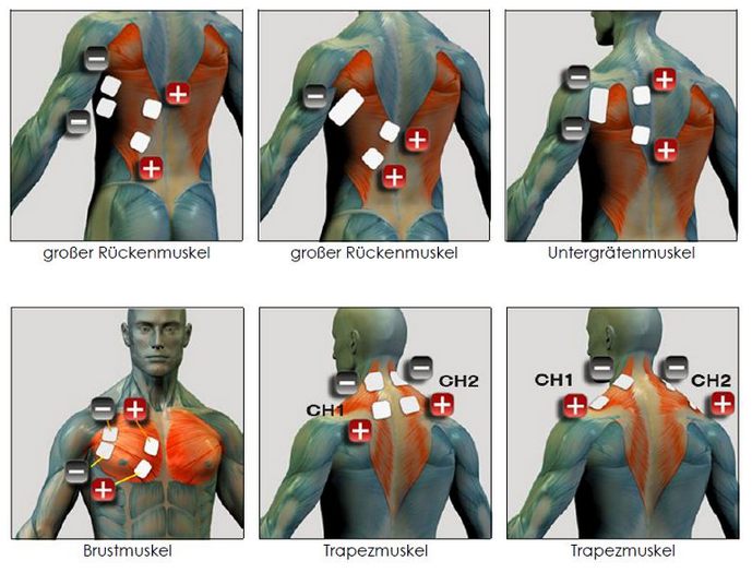 Elektroden Positionen für Elektrostimulation