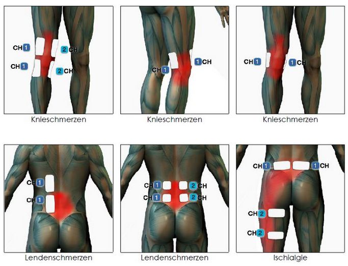 TENS Elektrodenposition