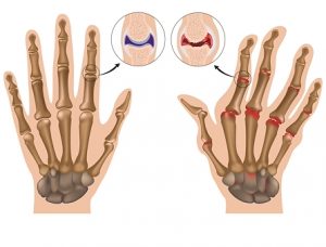 Behandlungsprotokolle der Magnetoenergy-Geräte: Rheumatologie