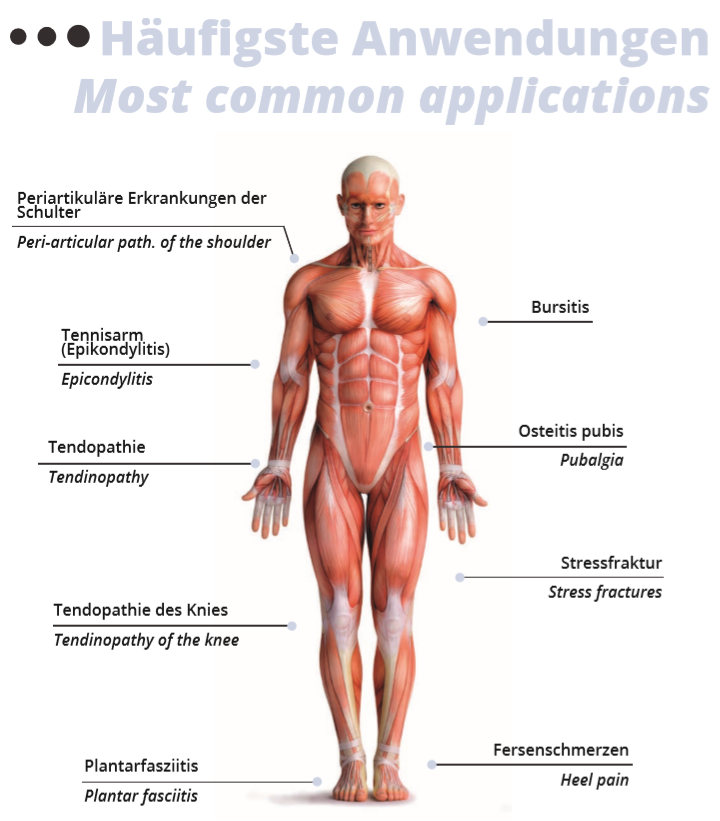 Anwendungen der Stoßwellentherapie